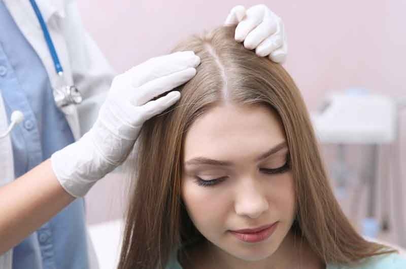 Woman hair with Androgenetic Alopecia