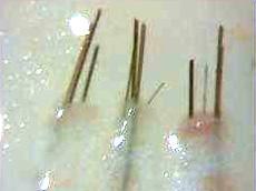 3 hair group type 2