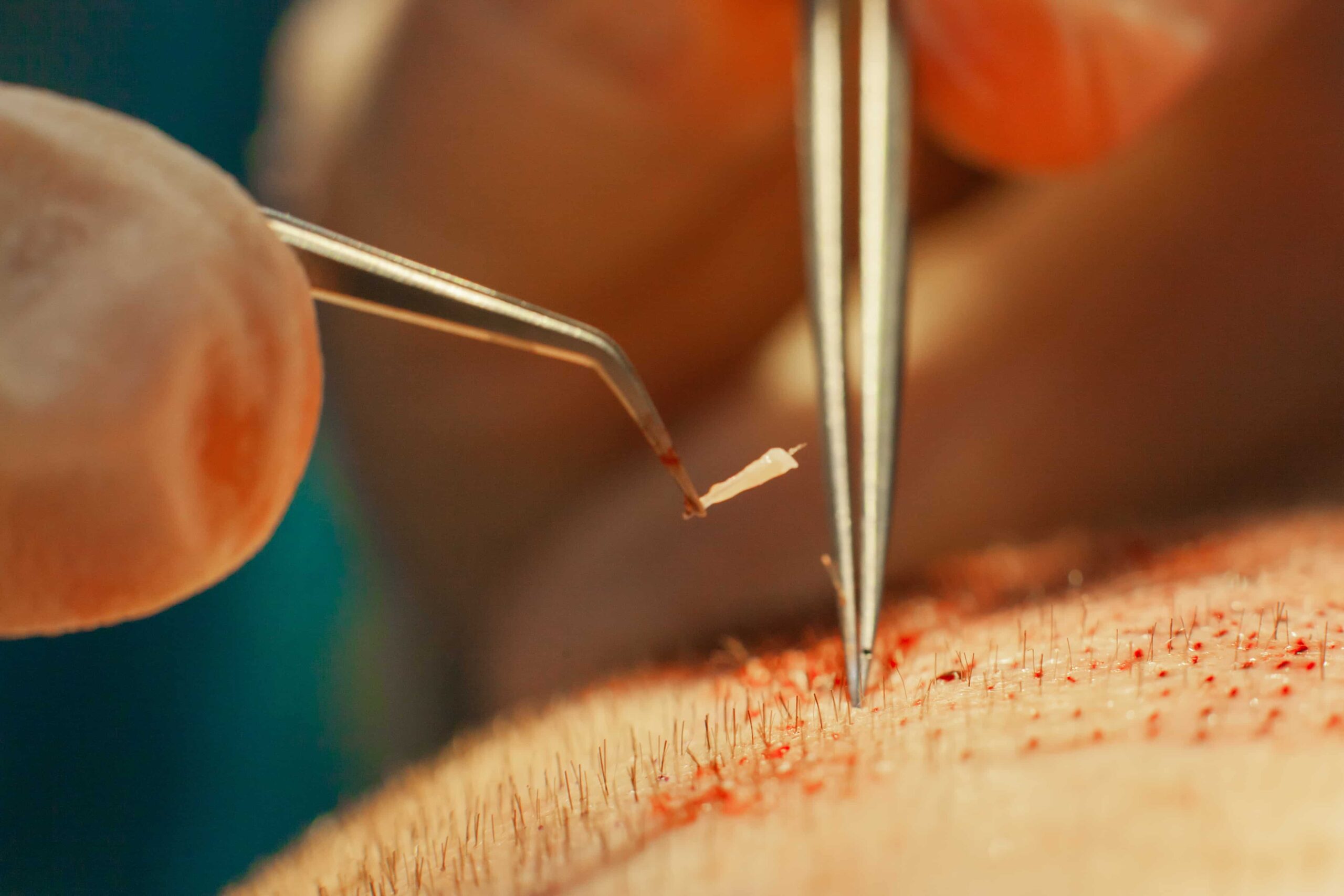 Close-up of a hair transplant procedure, showing a follicular unit being carefully placed into an incision on the scalp.