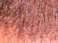History of Hair Transplantation Surgery, Forhair