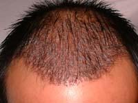 History of Hair Transplantation Surgery, Forhair