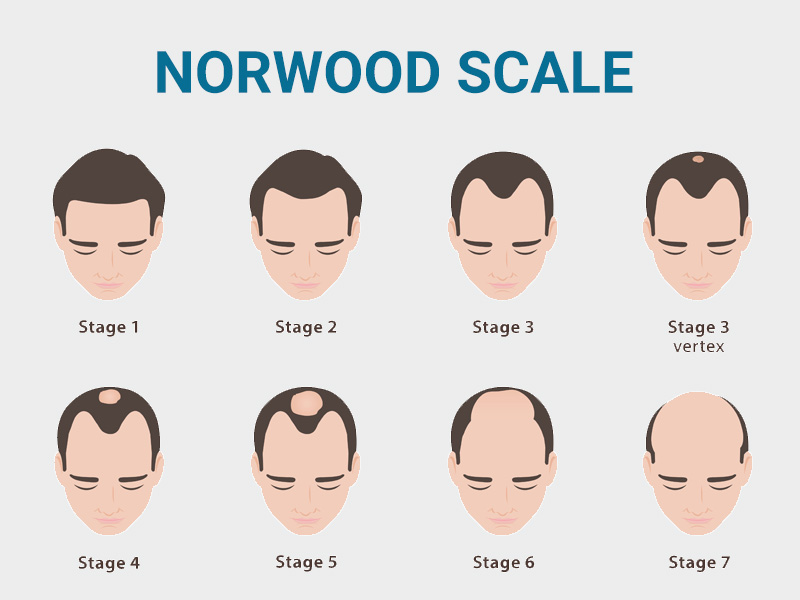 Norwood Scale hair loss classification chart showing stages I through VII of male pattern baldness