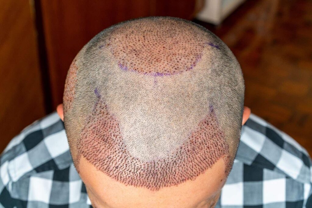 Overhead view of a man's head after a hair transplant, showing the shaved donor and recipient areas with visible red dots and purple markings.