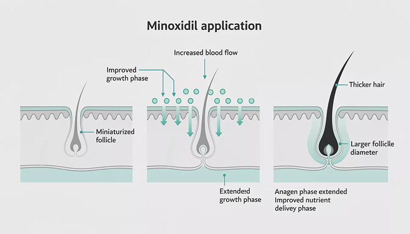 Diagram showing how minoxidil widens blood vessels and stimulates hair follicle growth phase