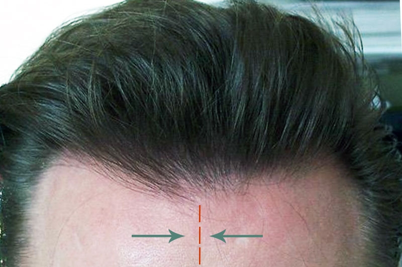 Natural Hairline Design Presentation