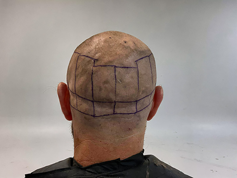 Patient's donor area showing how to measure donor area dimensions from temple to temple for hair transplant planning"