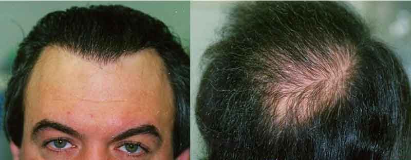 hair mass index transferred after