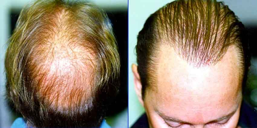 hair mass index transferred after2