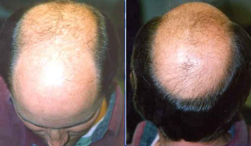 hair mass index transferred before2