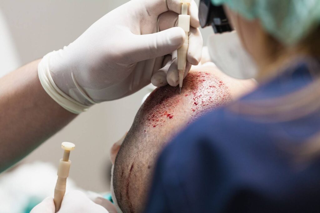 Hair transplant procedure performed by a highly skilled surgical team.