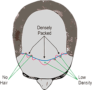 Aesthetics and Natural Hairline Design, Forhair