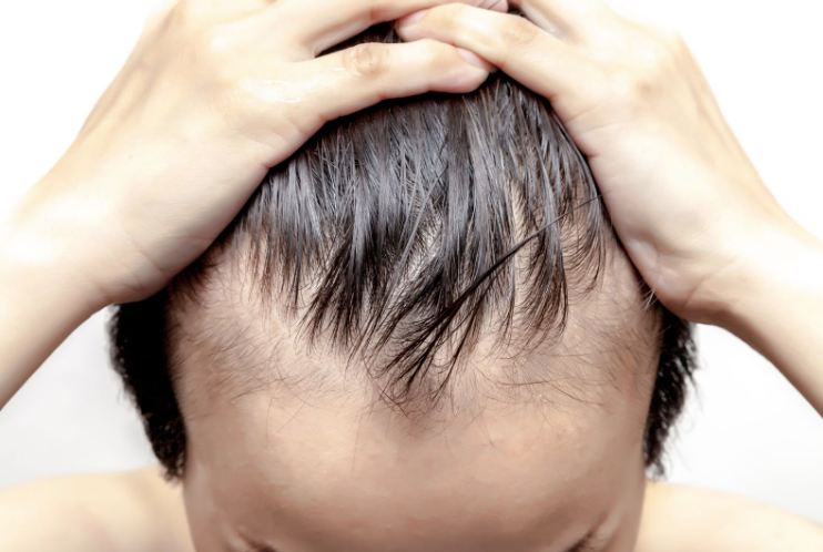 Man’s natural hairline with new hair growth.