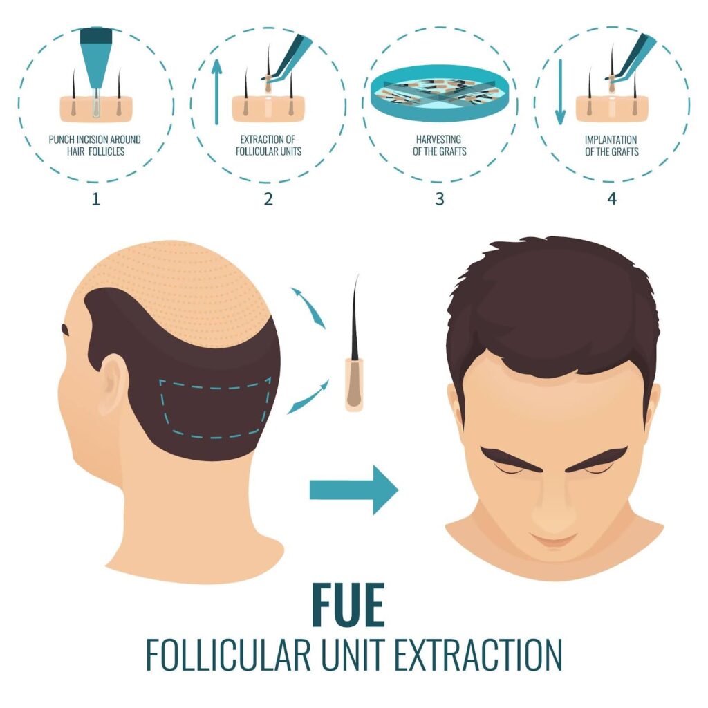 Infographic: the stages of FUE procedure.