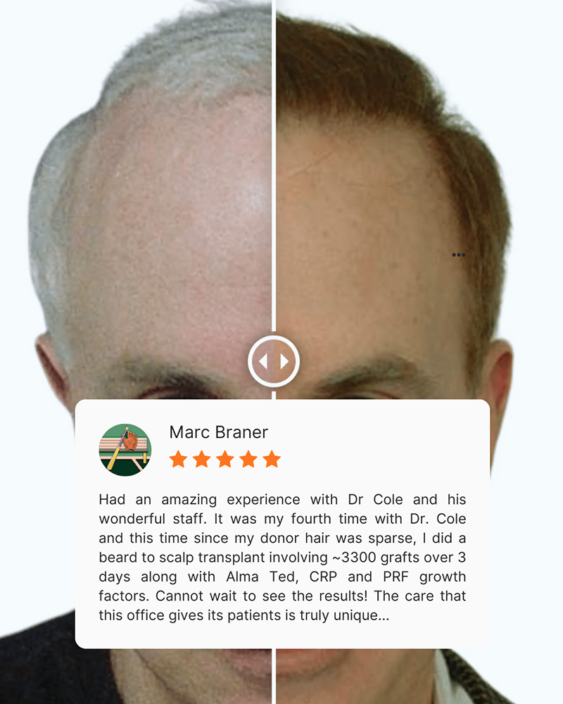 Body hair transplant case results and testimonial