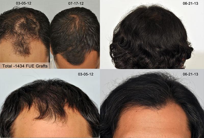 natural hairline