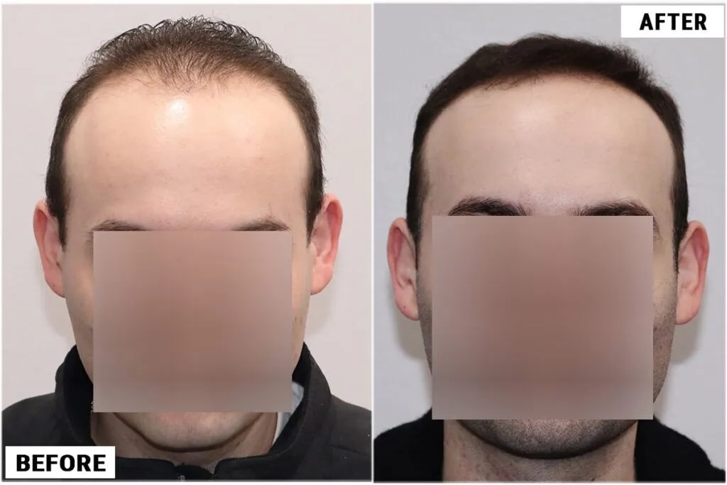 Topical Finasteride #1 Patient Snapshot, ForHair1