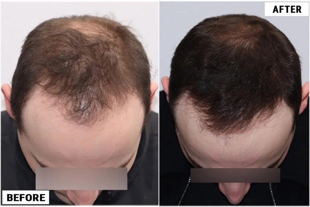 Topical Finasteride #1 Patient Snapshot, ForHair