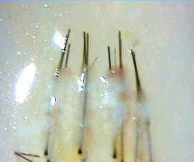 A magnified view shows several individual hair follicles grafts, each with a strand of hair, immersed in a clear liquid.