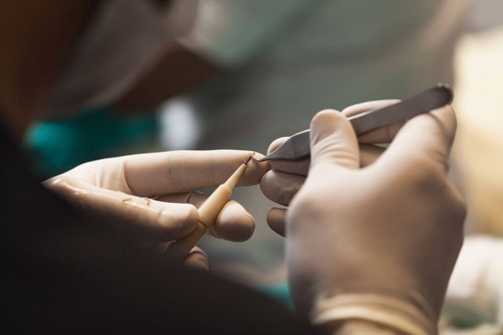 A close-up view shows a surgeon wearing white medical gloves using tweezers to handle a hair graft.