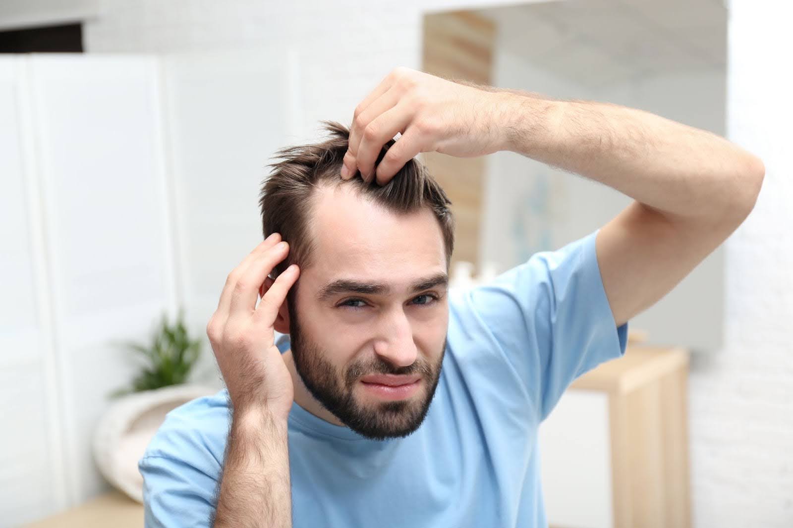 A young man with a significant hair loss problem looking unhappy and frustrated.