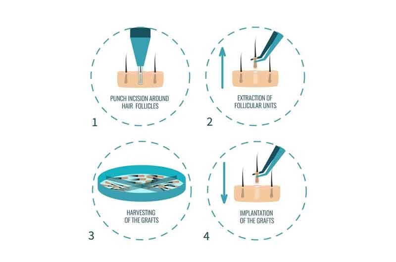 FUE punch size demonstration