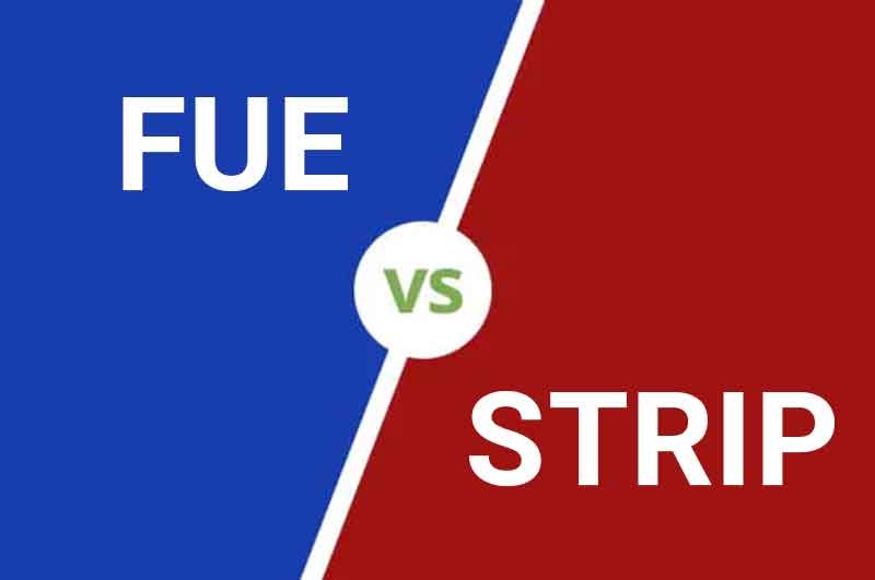 FUE vs. Strip