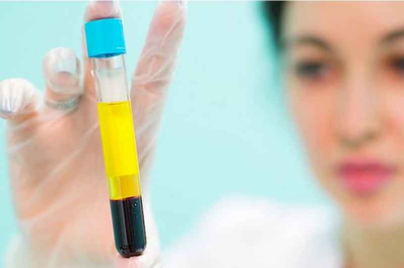 Platelet Rich Plasma, PRP