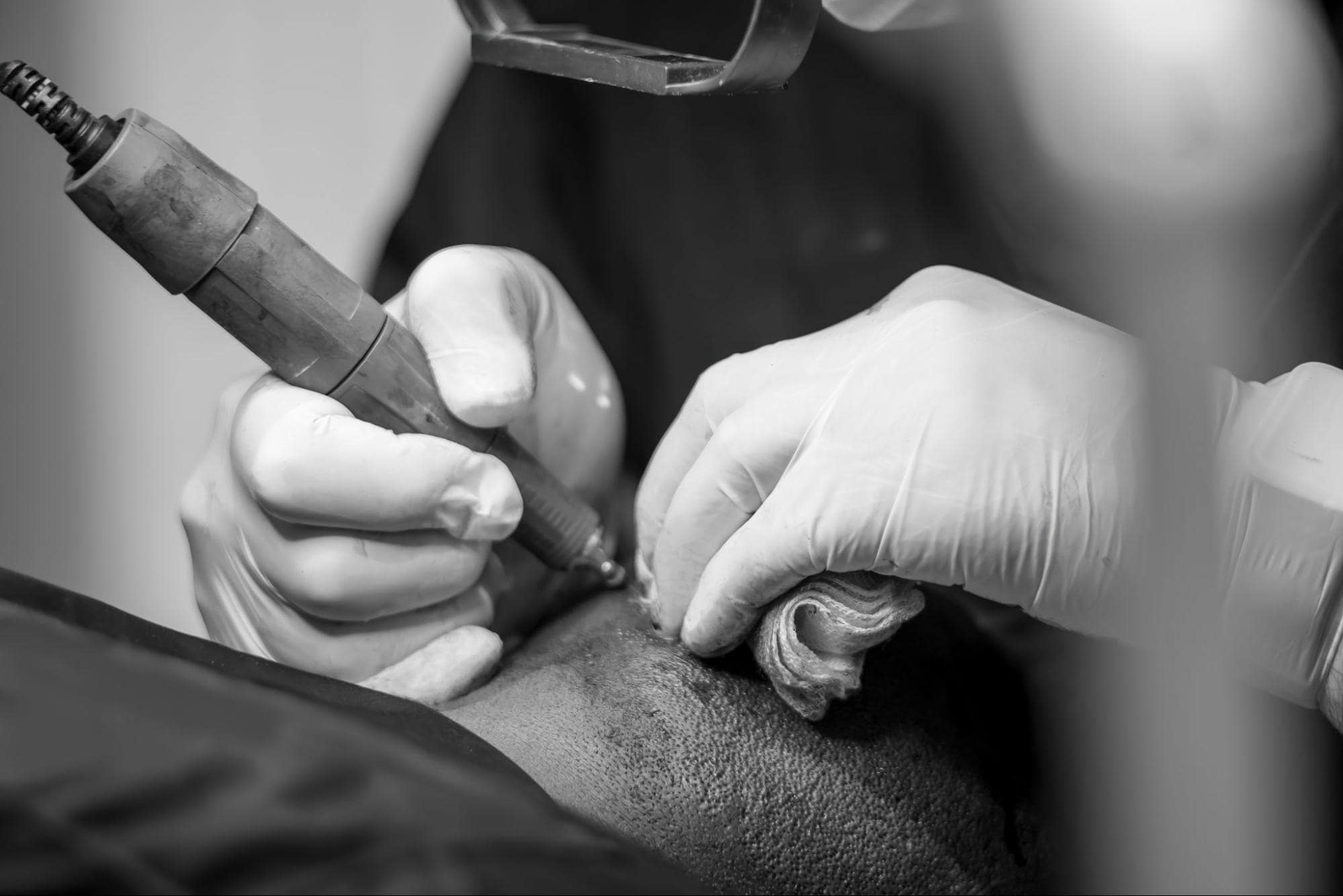 A black and white, close-up shot of a CIT hair transplant procedure.