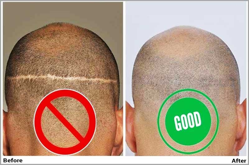 Hair restoration scar