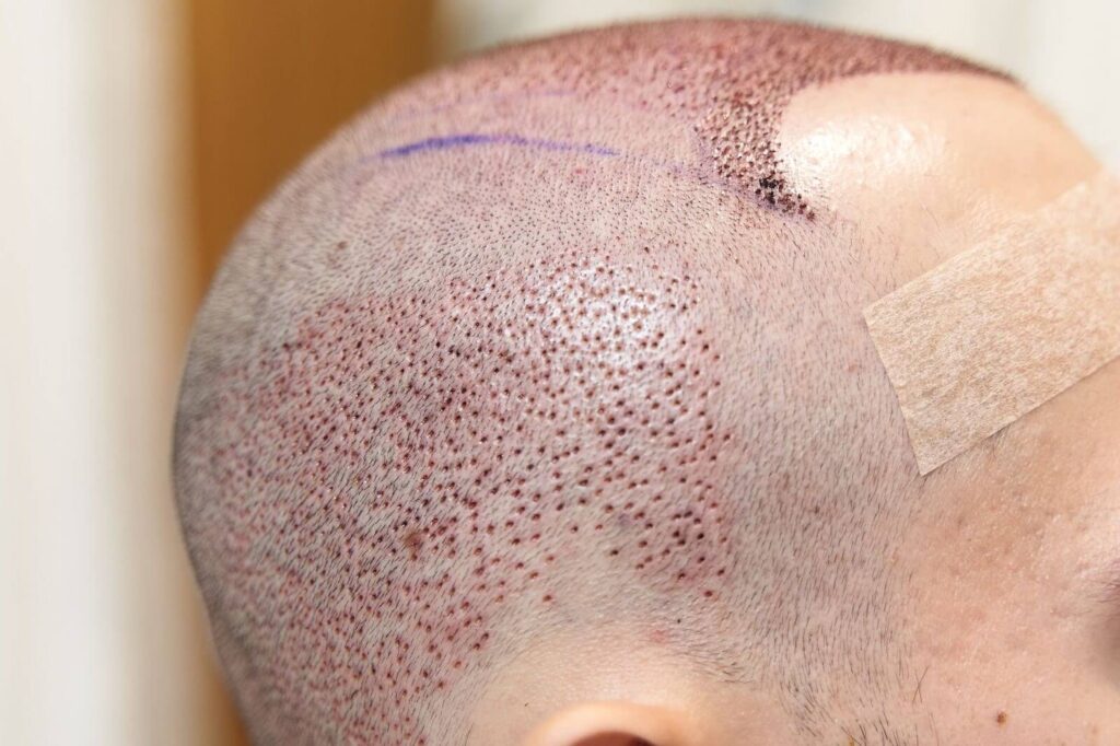 A close-up, side view of a person's head after a hair transplant, showing small scabs on the scalp and a bandage on the temple.