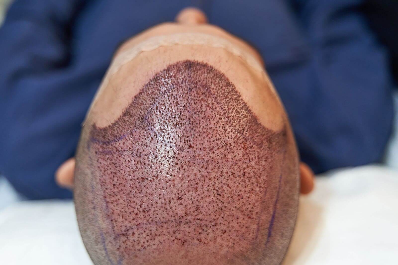 A top-down view of a person's head after a hair transplant, showing tiny scabs and short, newly implanted hairs on the scalp.
