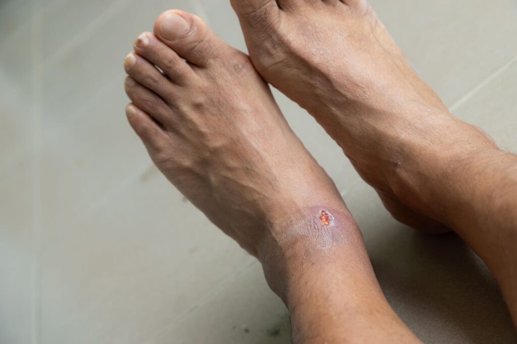 An image of a foot ulcer caused by diabetes.