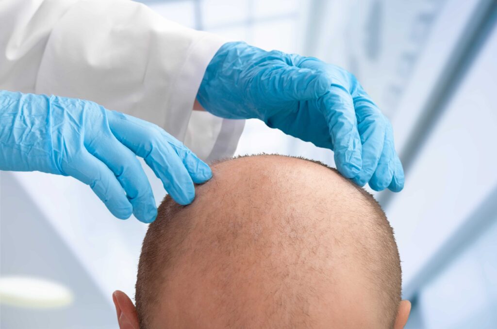 A medical professional in blue gloves examines a balding man's head.