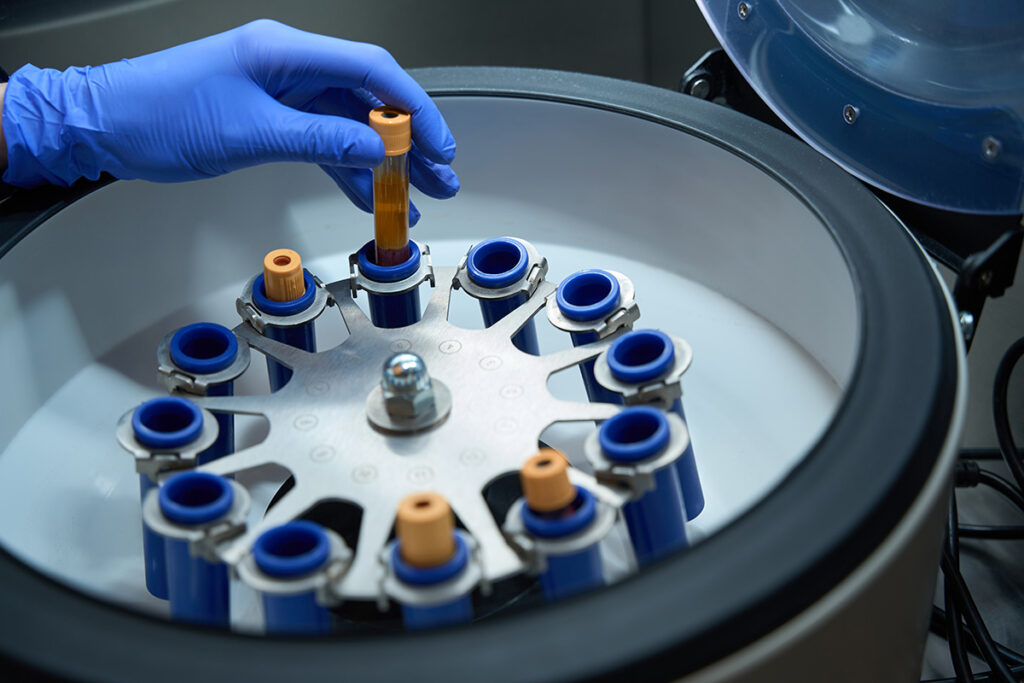 Platelet-rich plasma preparation via centrifuge for hair graft enhancement