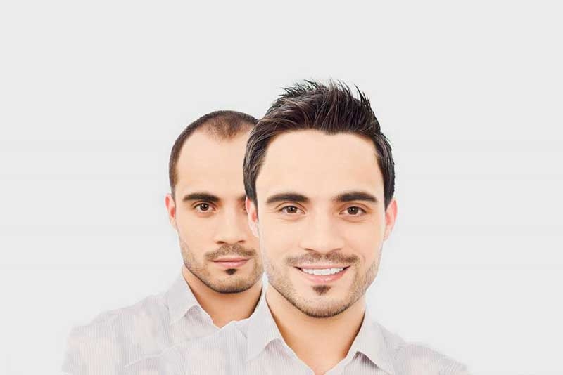 male hair loss before and after