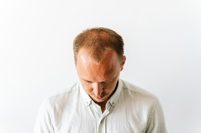 Men with hair loss looking for options