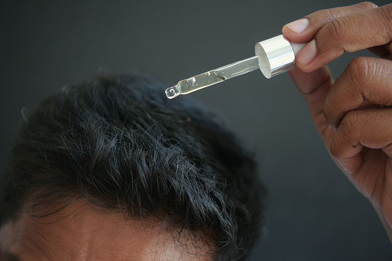 Man apply topical finasteride for hair loss