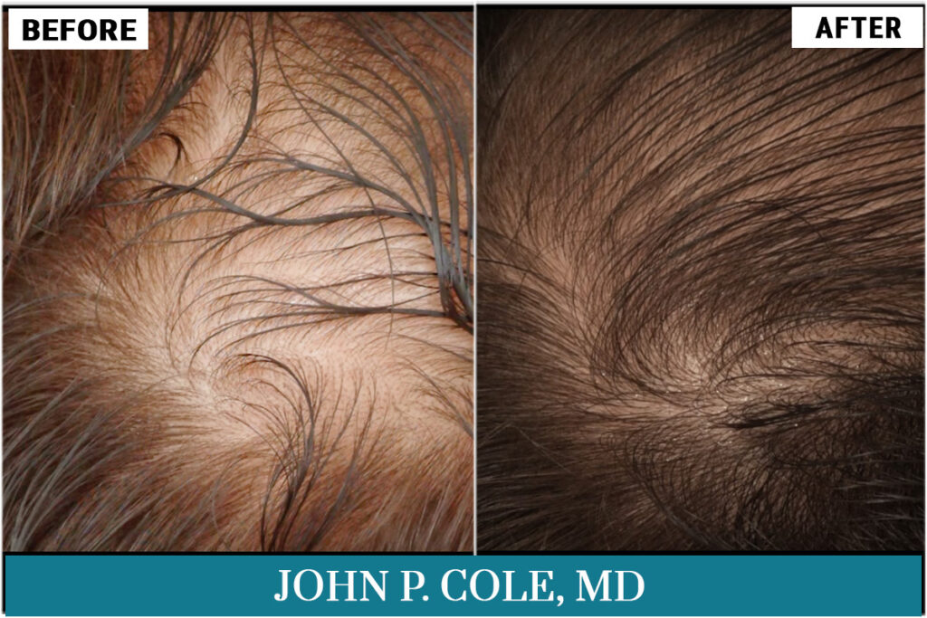 PRP results by John P. Cole, MD