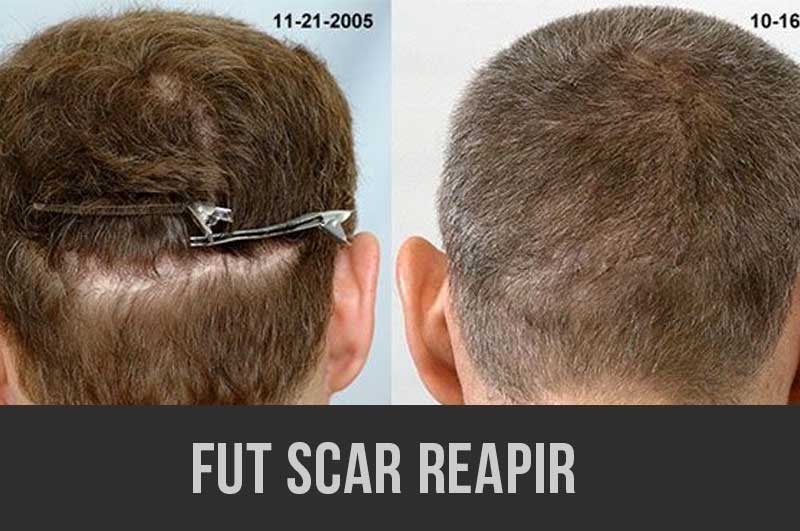 FUE strip scar repair results