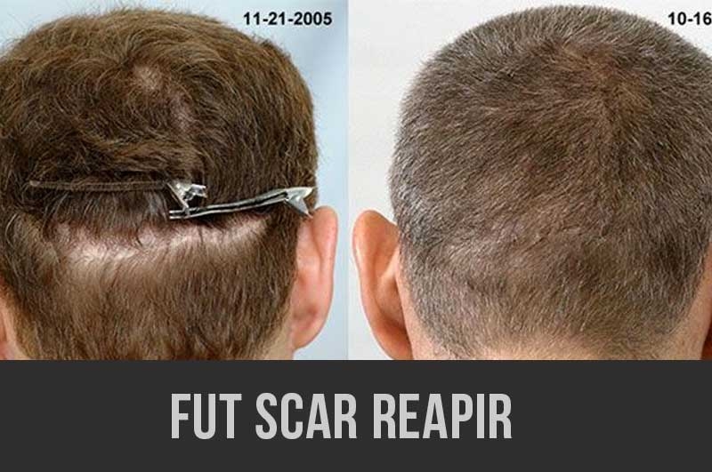 FUE scar repair before and after