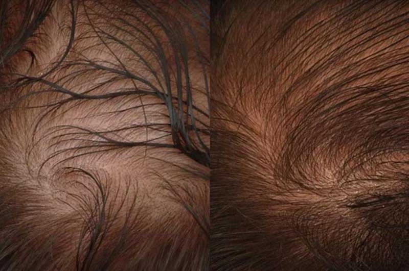 Before and after crown results Improved Coverage with Acell and PRP, Forhair