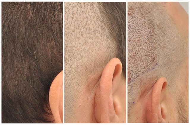 scalp micropigmentation before and after photo