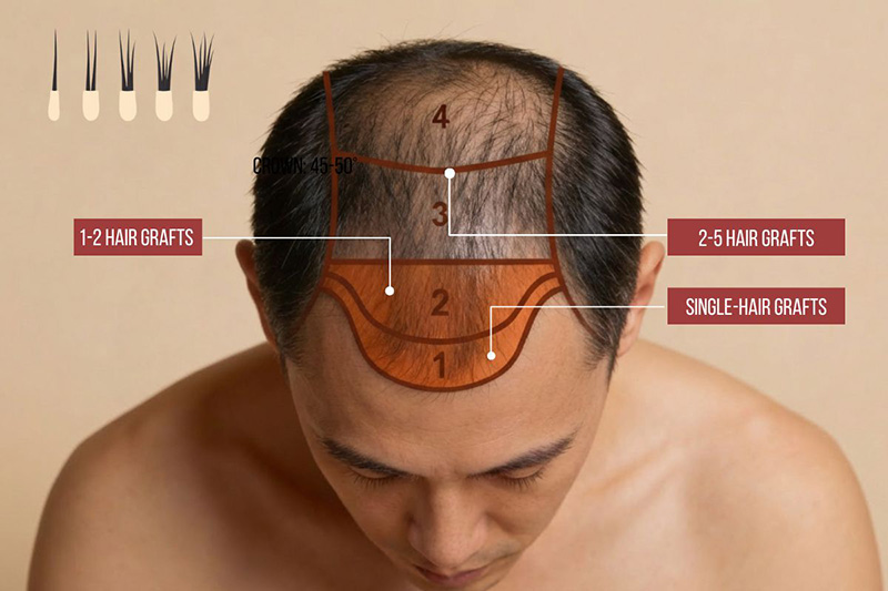 Three-zone hairline design showing graft placement strategy for natural FUE results