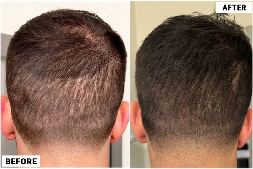 Before over harvested donor area and after repair by dr. cole