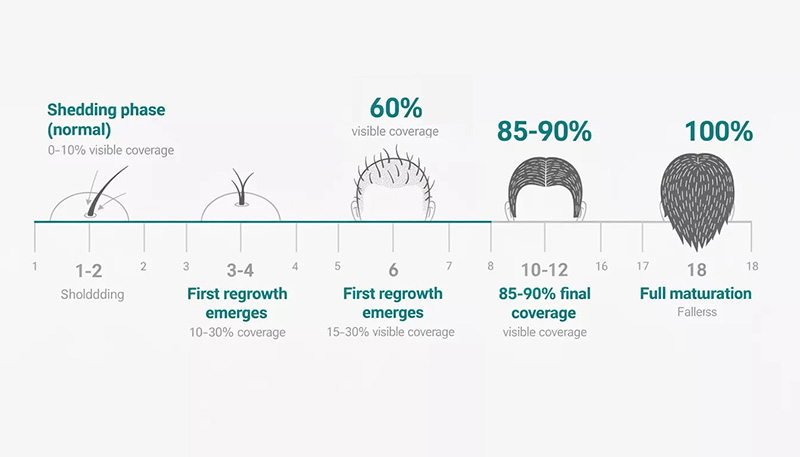 Month-by-month FUE hair transplant recovery timeline showing growth progression from procedure to final results