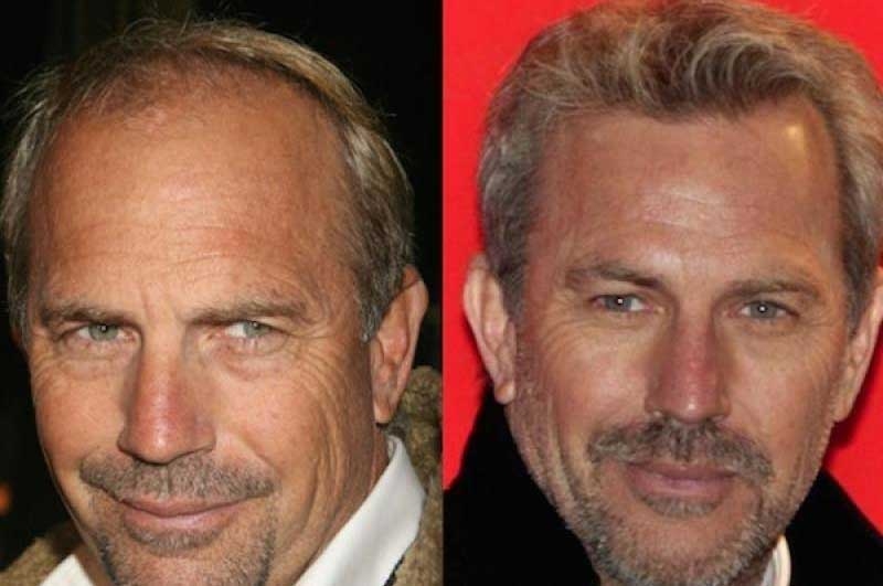 Celebrities Hair Restoration Popularity