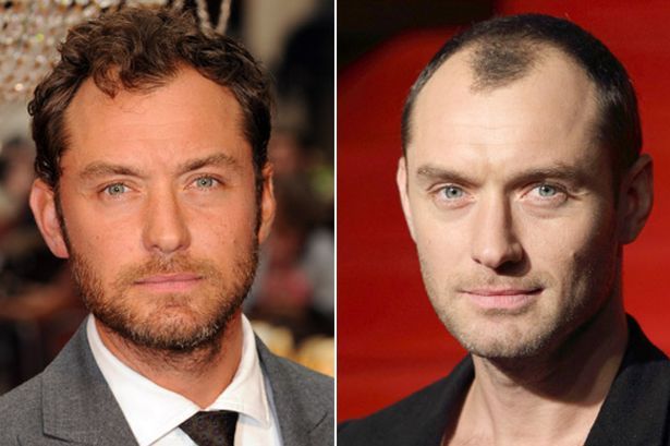 hair transplant celebreties jude law before and after