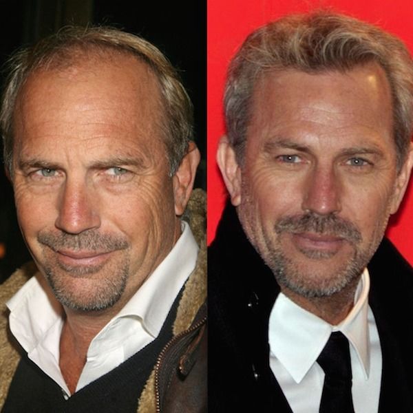 hair transplant celebreties kevin costner before and after