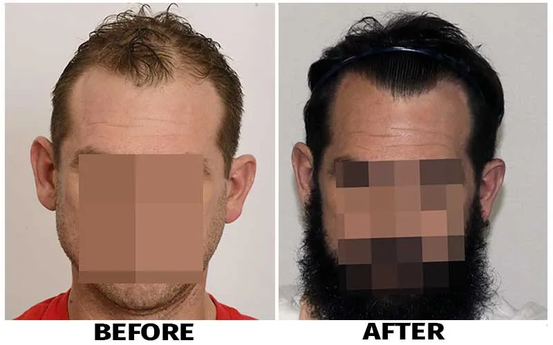 before and after results adipose stem cells on male