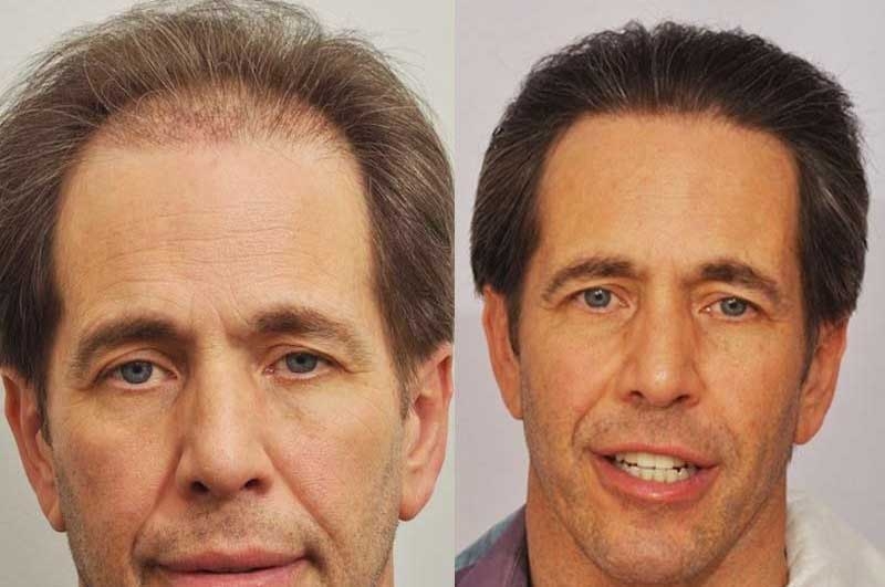Great hair restoration result